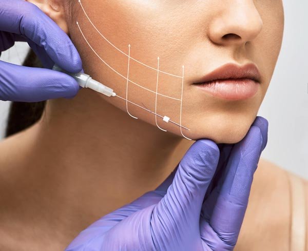 fili di biostimolazione riassorbibili clinica estetica europa firenze