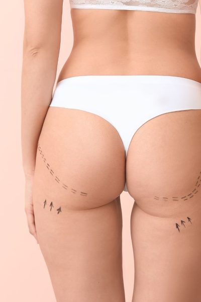 Lipoffilling glutei - clinica estetica europa - firenze